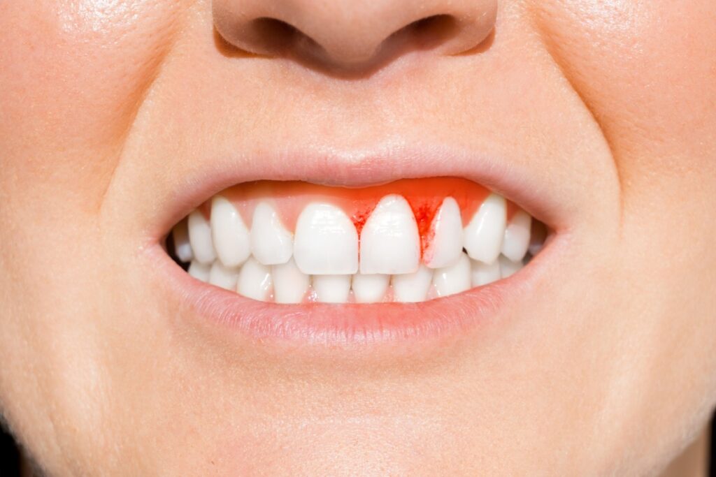 Close-up of teeth and gums showing bleeding after flossing, a common sign of gum inflammation or gingivitis.