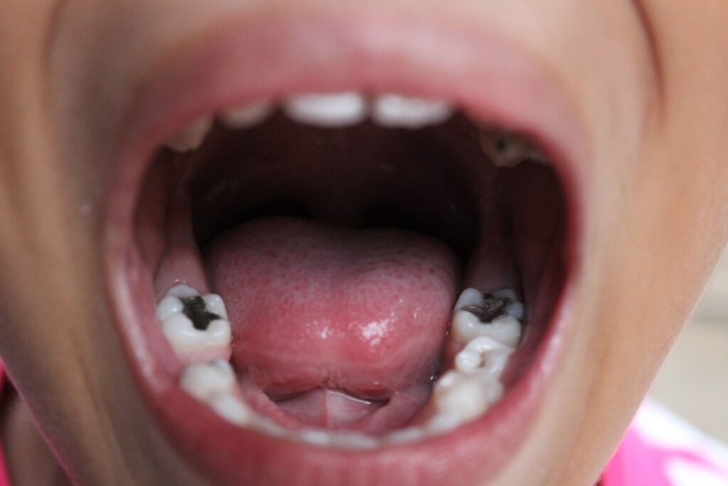 Close-up view of a child’s open mouth showing the lower molars, with visible dark cavities or tooth decay on both sides near the back of the mouth.
