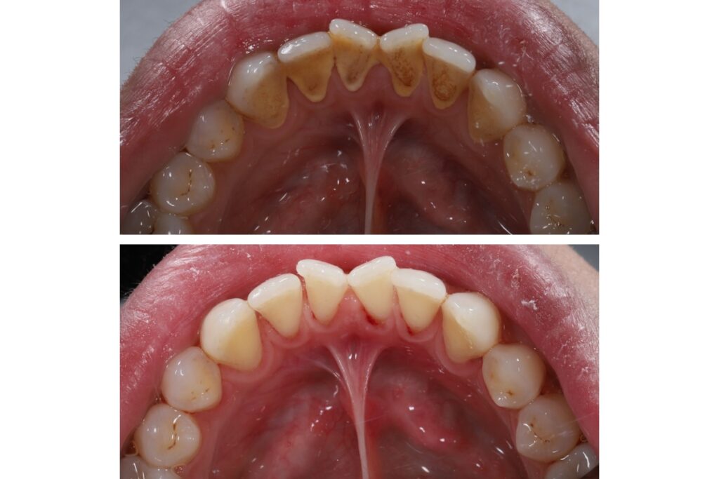 Side-by-side dental images showing the inside of the upper teeth before and after cleaning; the top image displays yellowish tartar buildup on the inner surfaces of the front teeth, while the bottom image shows the same area clean and free of deposits after dental scaling.