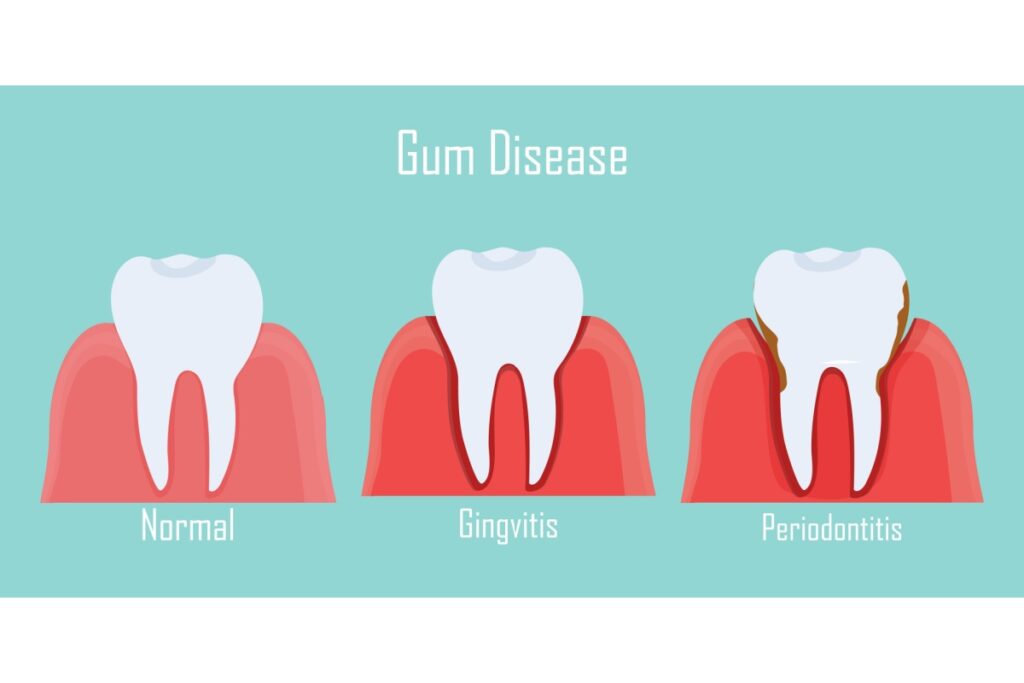 Gum disease progression illustration showing normal, gingivitis, and periodontitis.