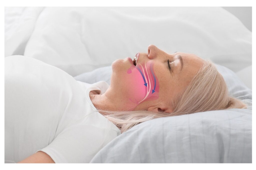 Woman mouth breathing while sleeping with arrows showing air flow in mouth.